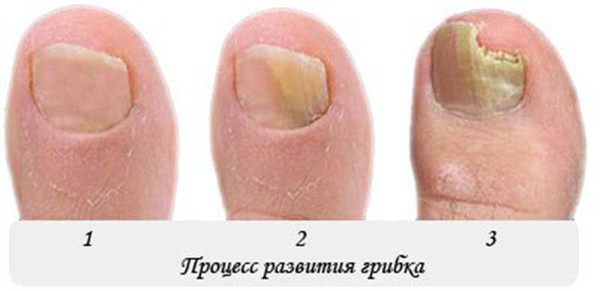 Грибок ногтя на ноге лечение в домашних условиях